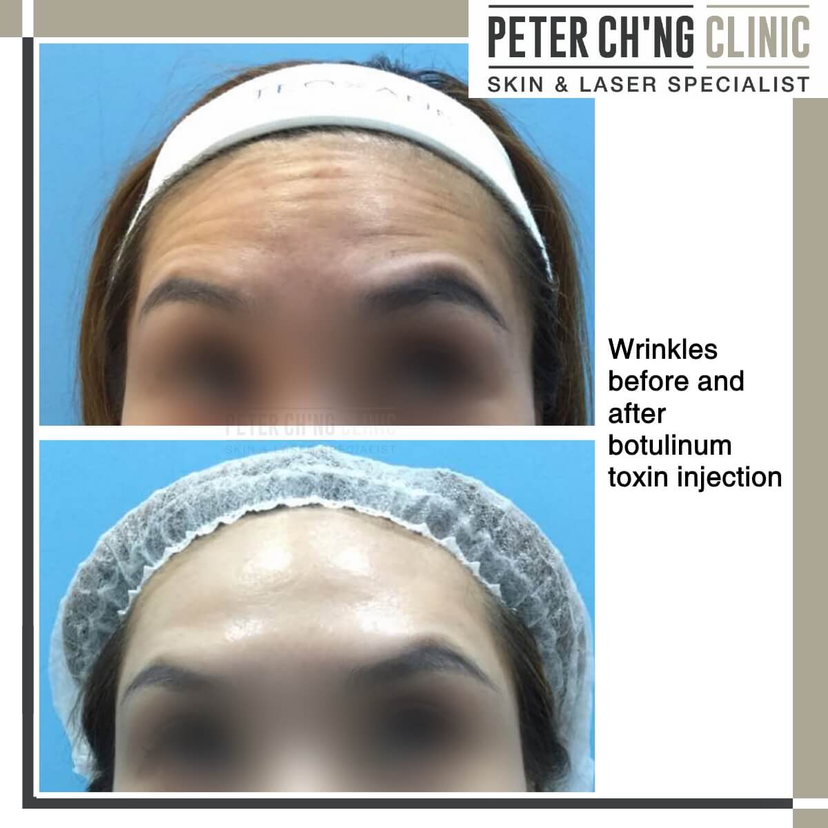 Wrinkles before and after botox