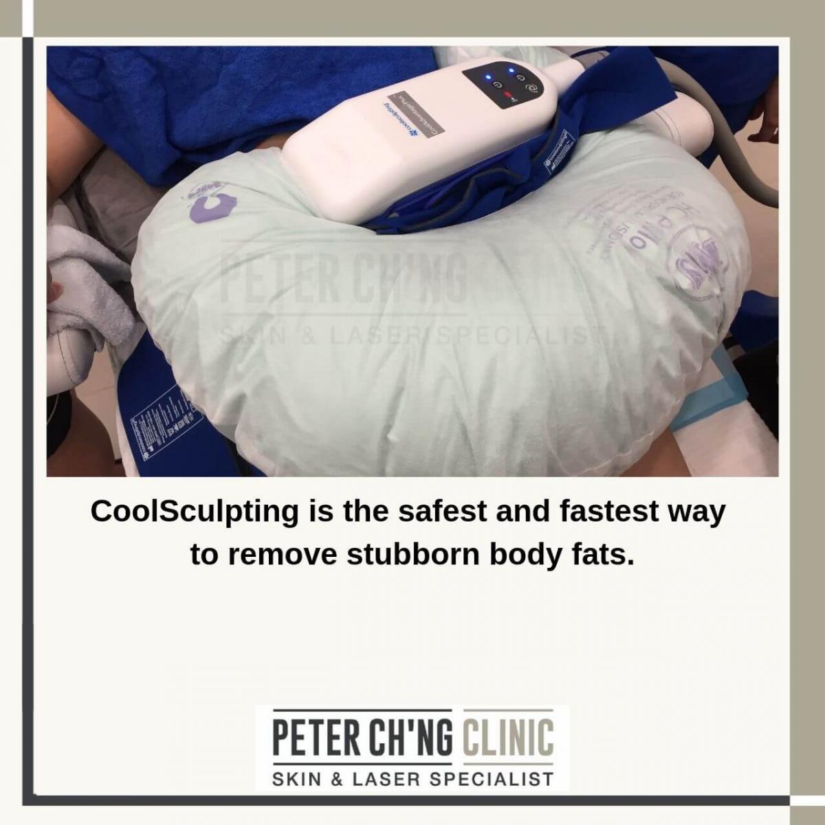 CoolSculpting