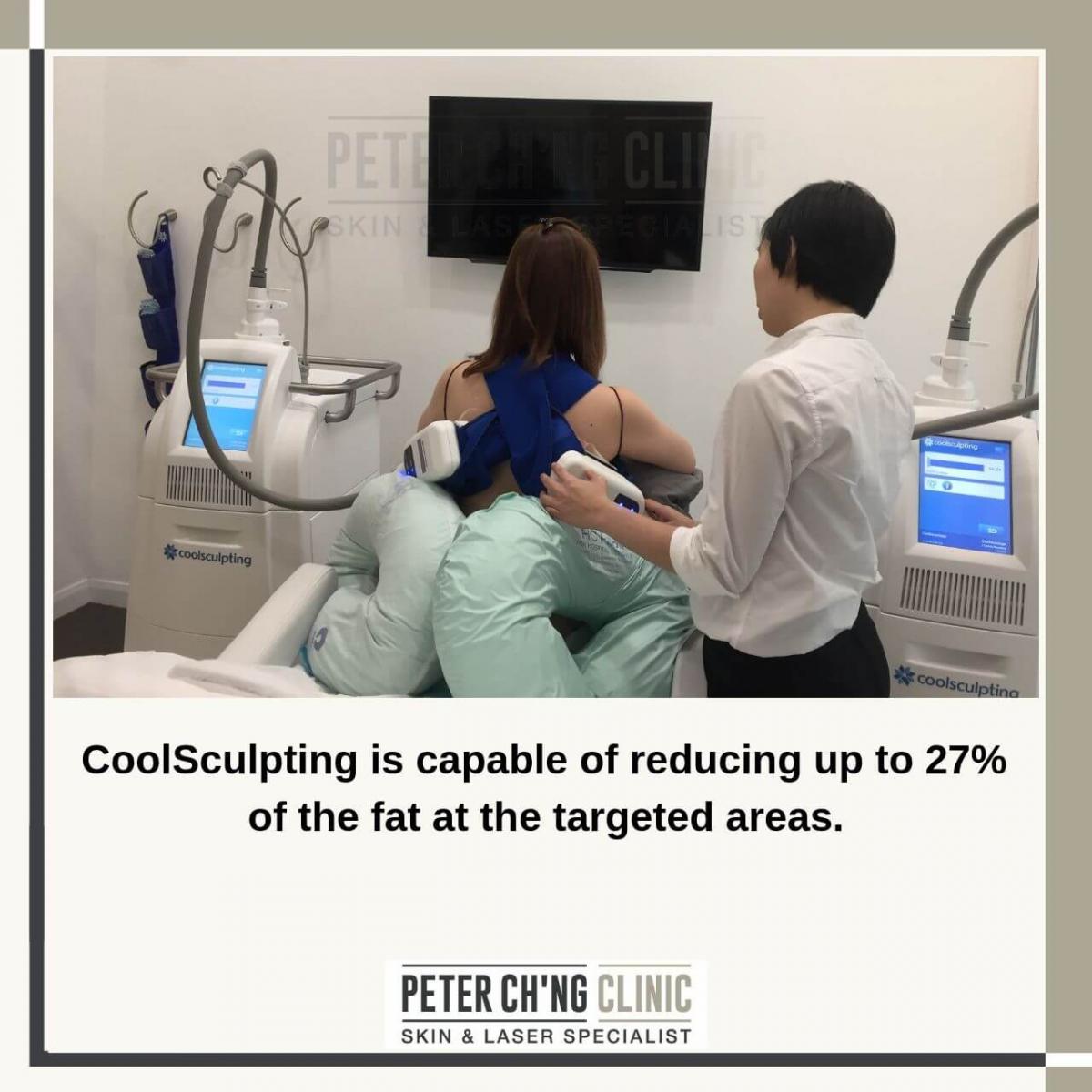 CoolSculpting is capable of reducing up to 27% of the fat at the targeted area.