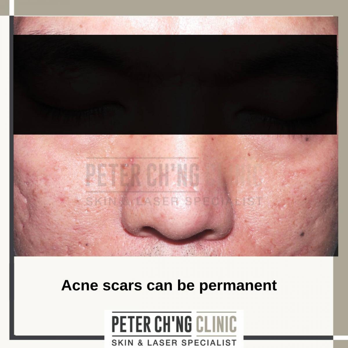 Acne scars