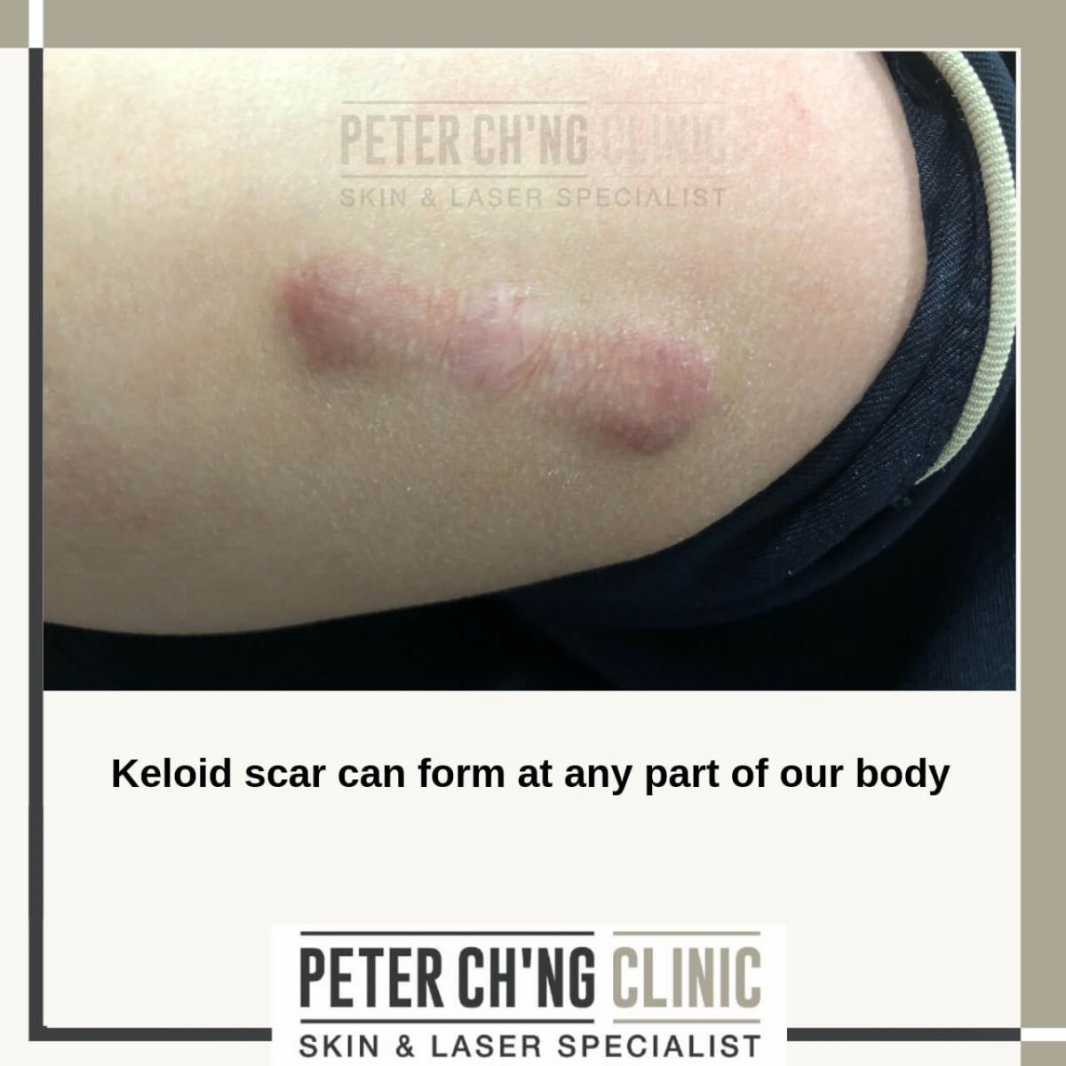 Keloid scars