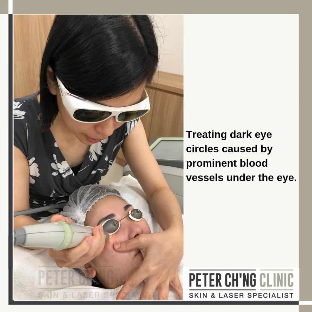 Dark eye circles