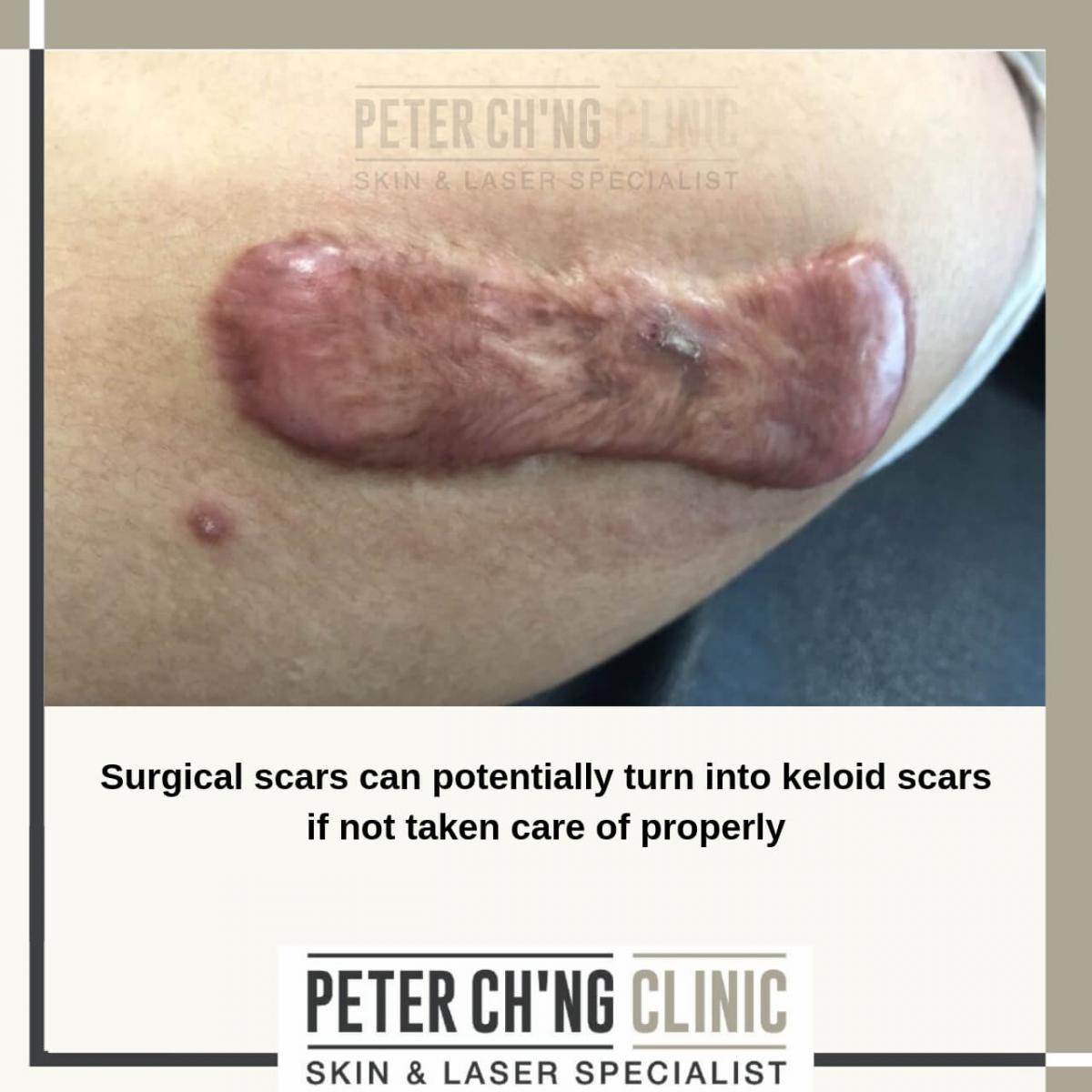 Surgical scars
