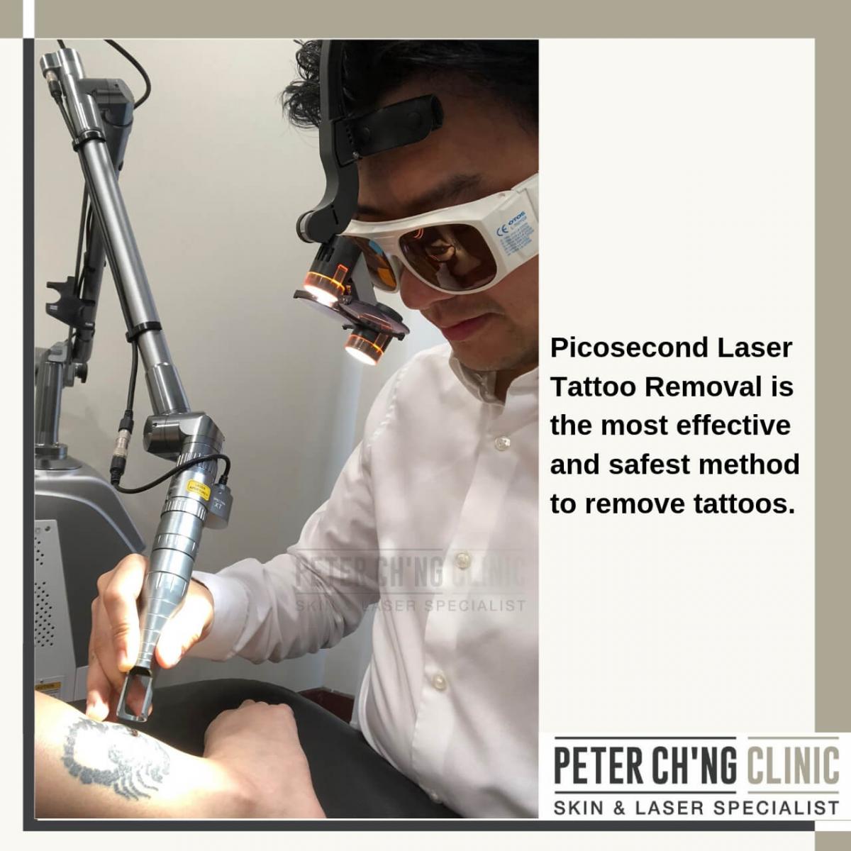 Laser Tattoo Removal