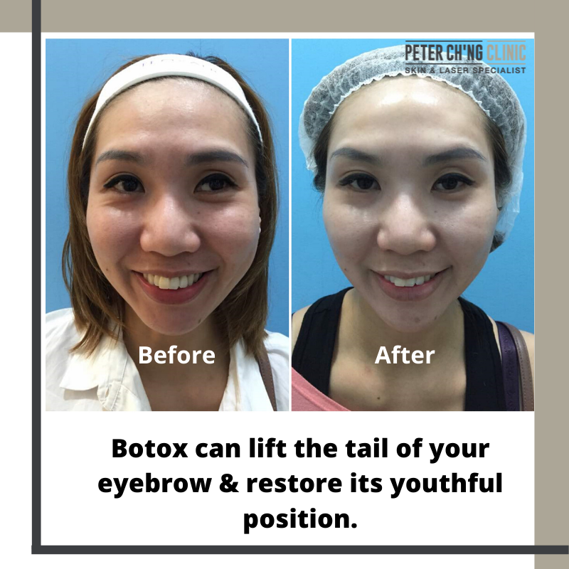 Botox for hooded eyebrows