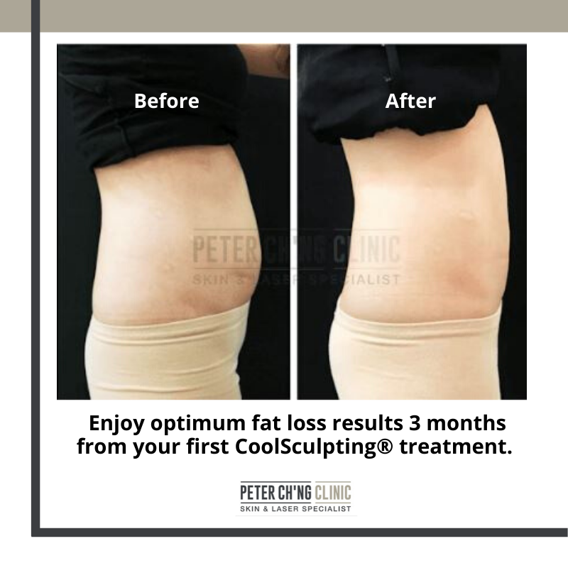 5 Reasons to Consider Body Contouring with CoolSculpting®