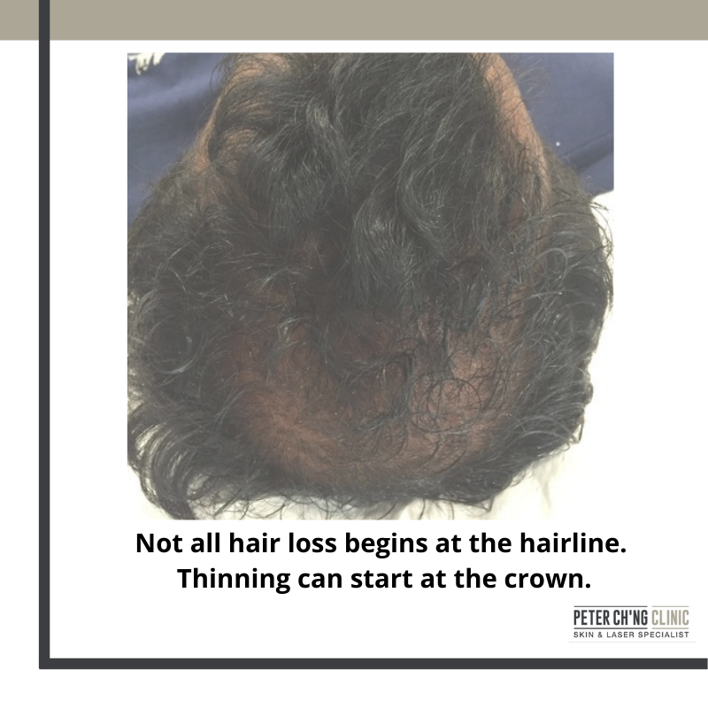 How Do I Know If I'm Losing My Hair? 4 Signs of Hair Loss | Peter Ch'ng  Skin Specialist - KL, Malaysia