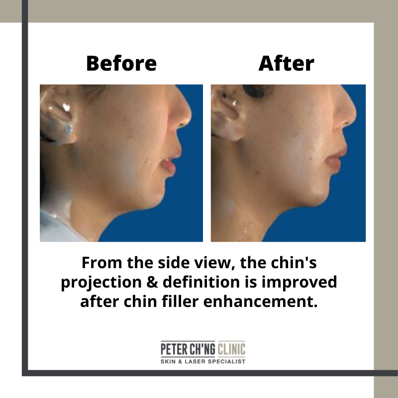 LA %20Side%20Profile%20Before%20and%20After%20Chin%20Enhancement%20with%20Fillers%20%282%29