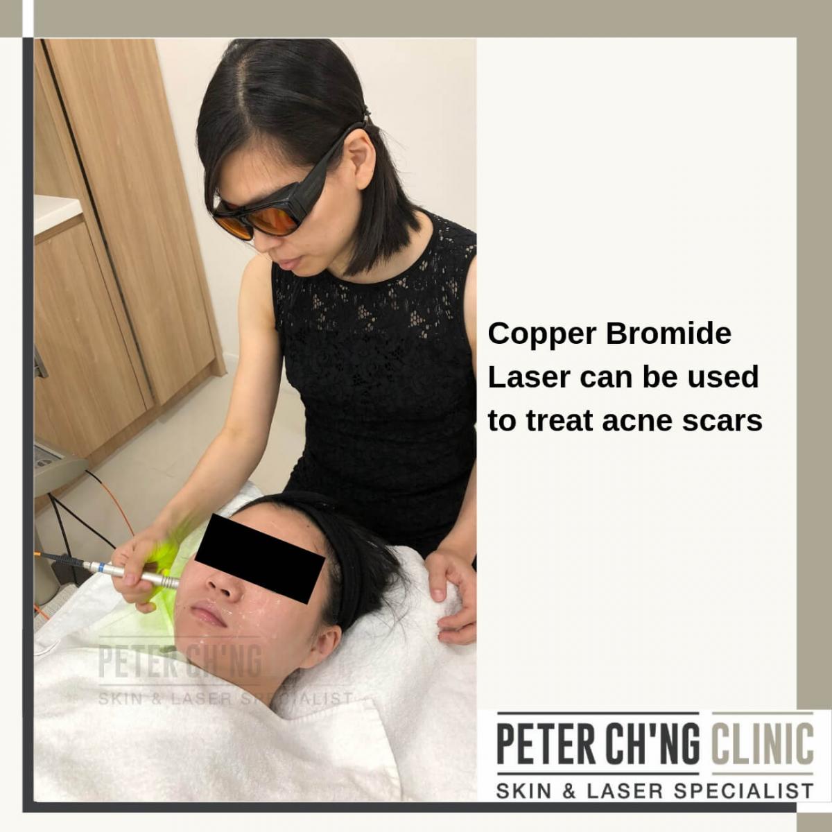 Copper Bromide Laser