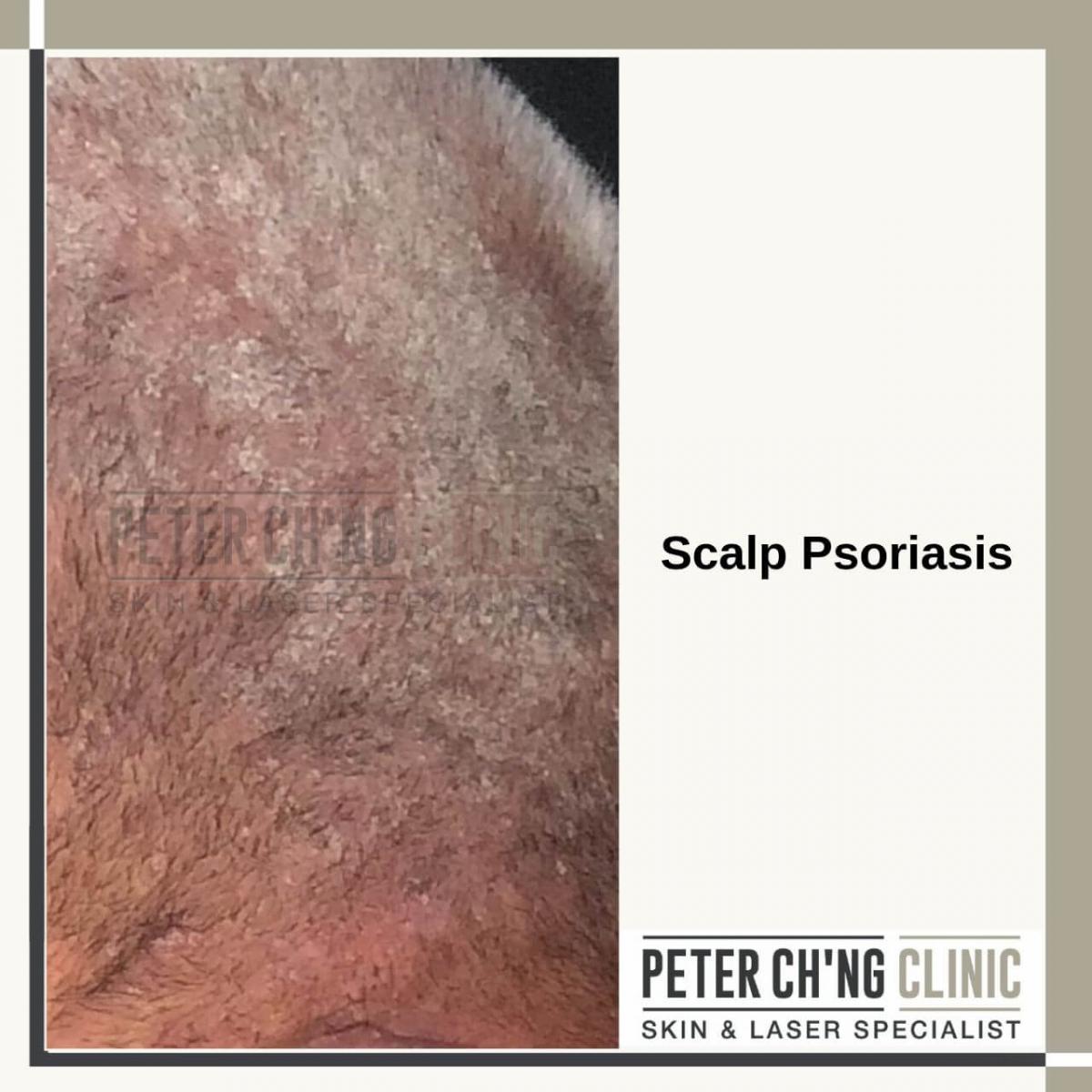 Scalp psoriasis