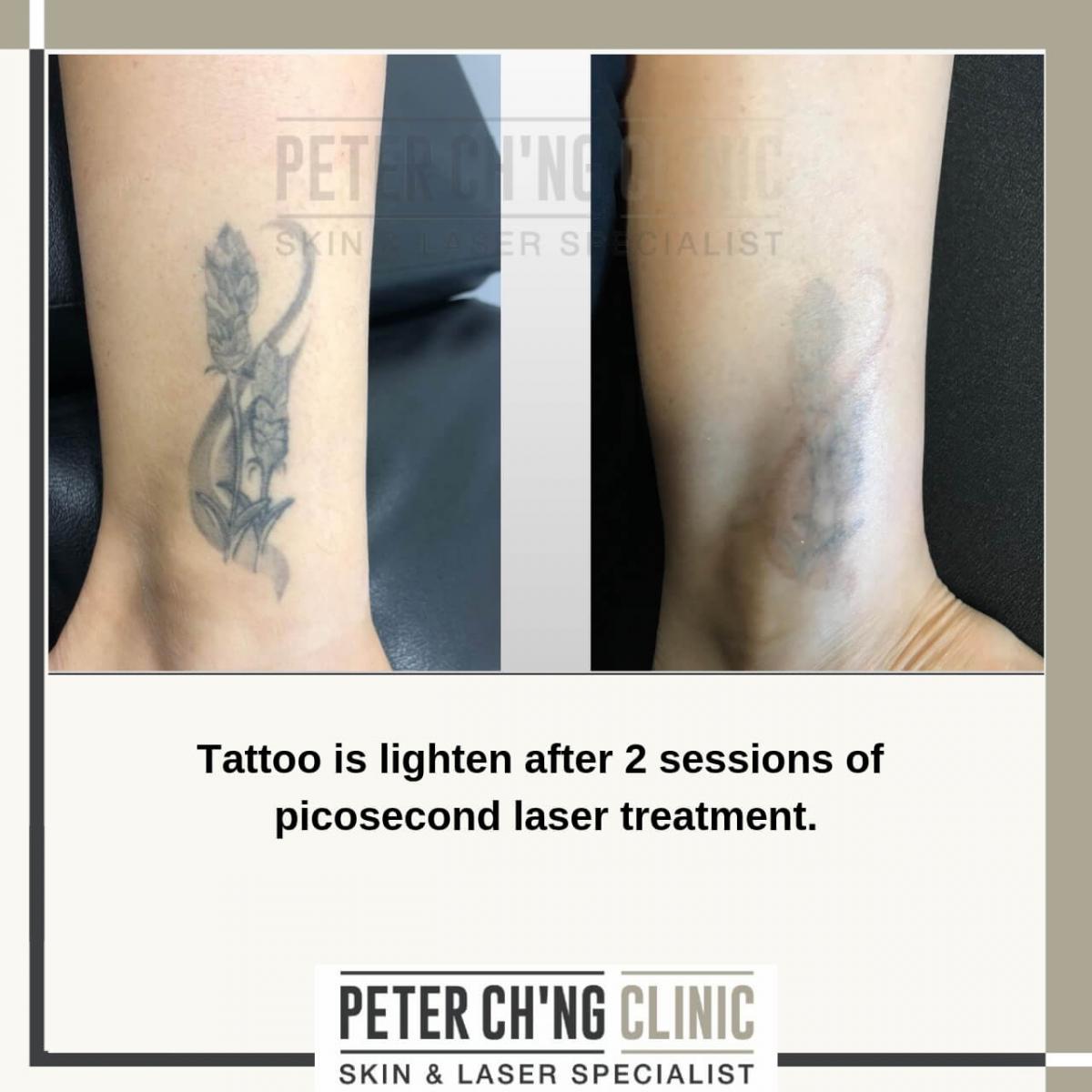 Laser Tattoo removal clinic- Get rid of unwanted tattoos