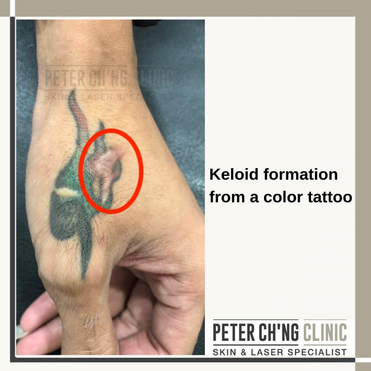 Keloids formation of a color tattoo