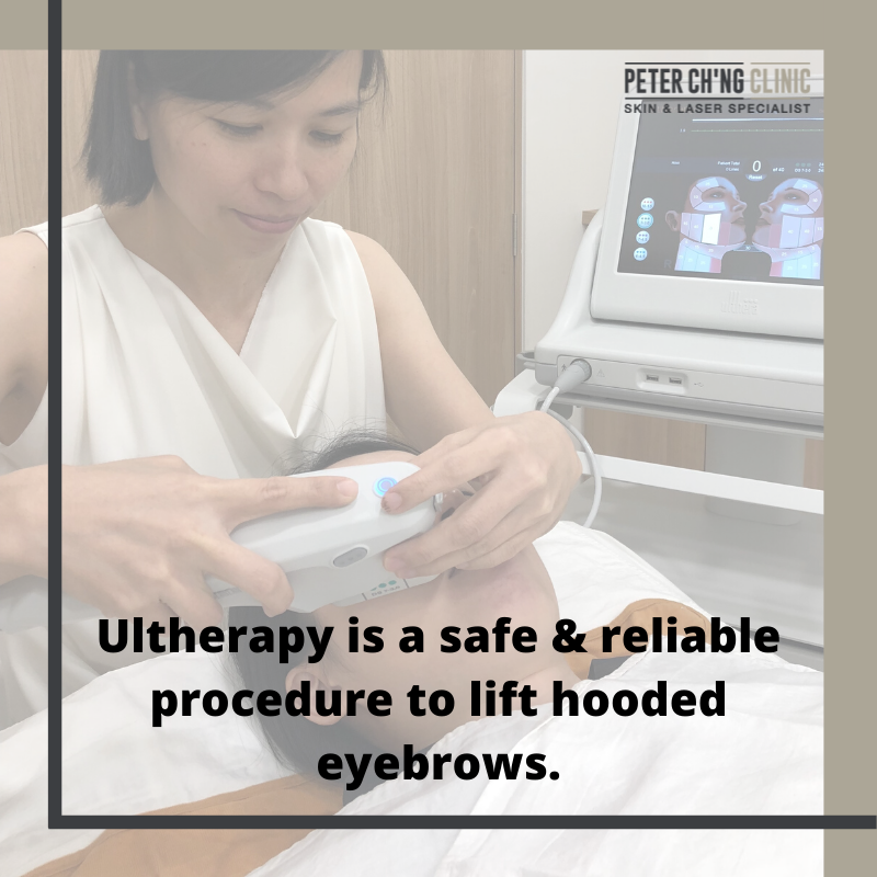 Ulthera for droopy eyebrows
