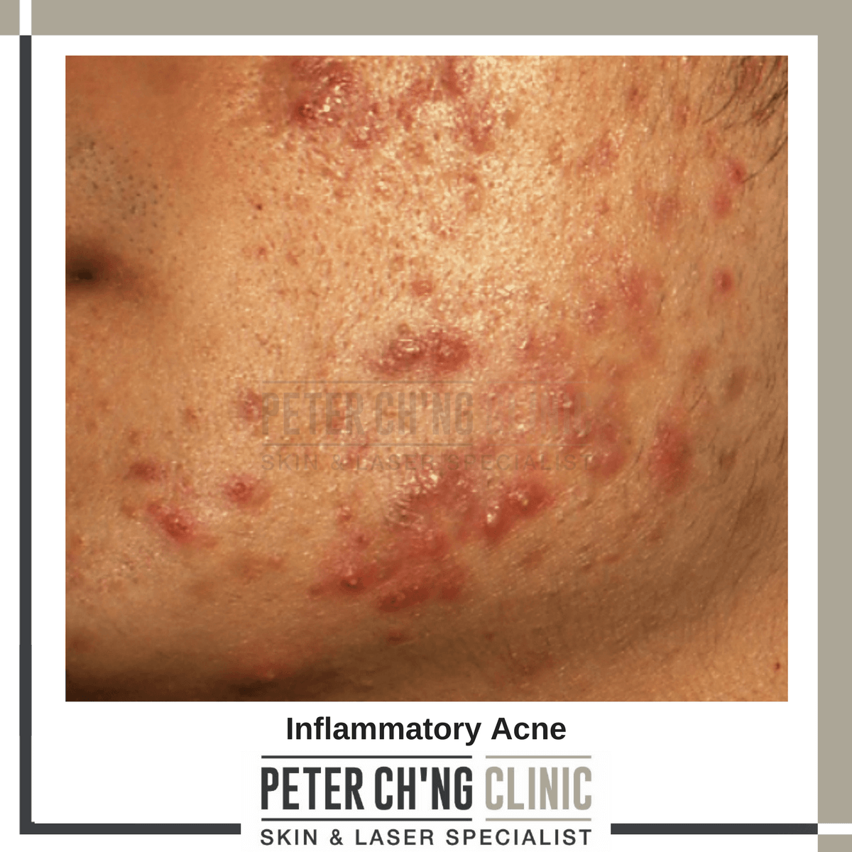 Inflammatory acne