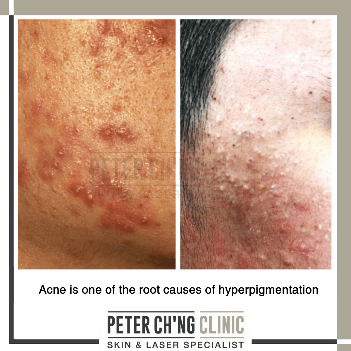 Acne and hyperpigmentation