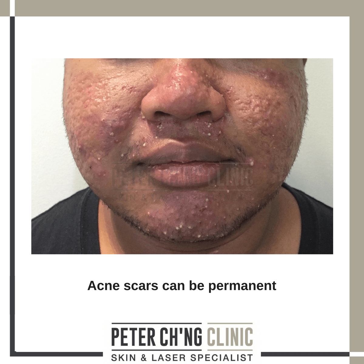 Acne scars