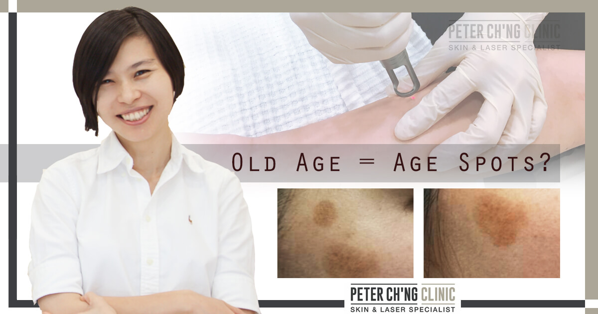 Age Spots Not Necessarily Due To Old Age Peter Ch Ng Skin Specialist Kl Malaysia