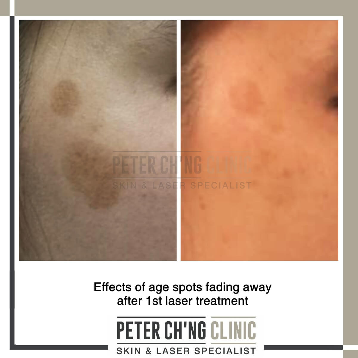 Laser treatment for age spots