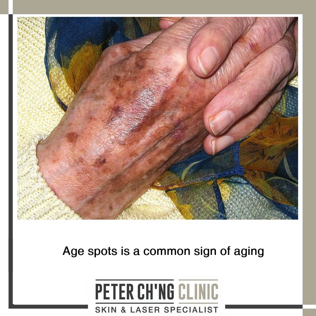 Age spots