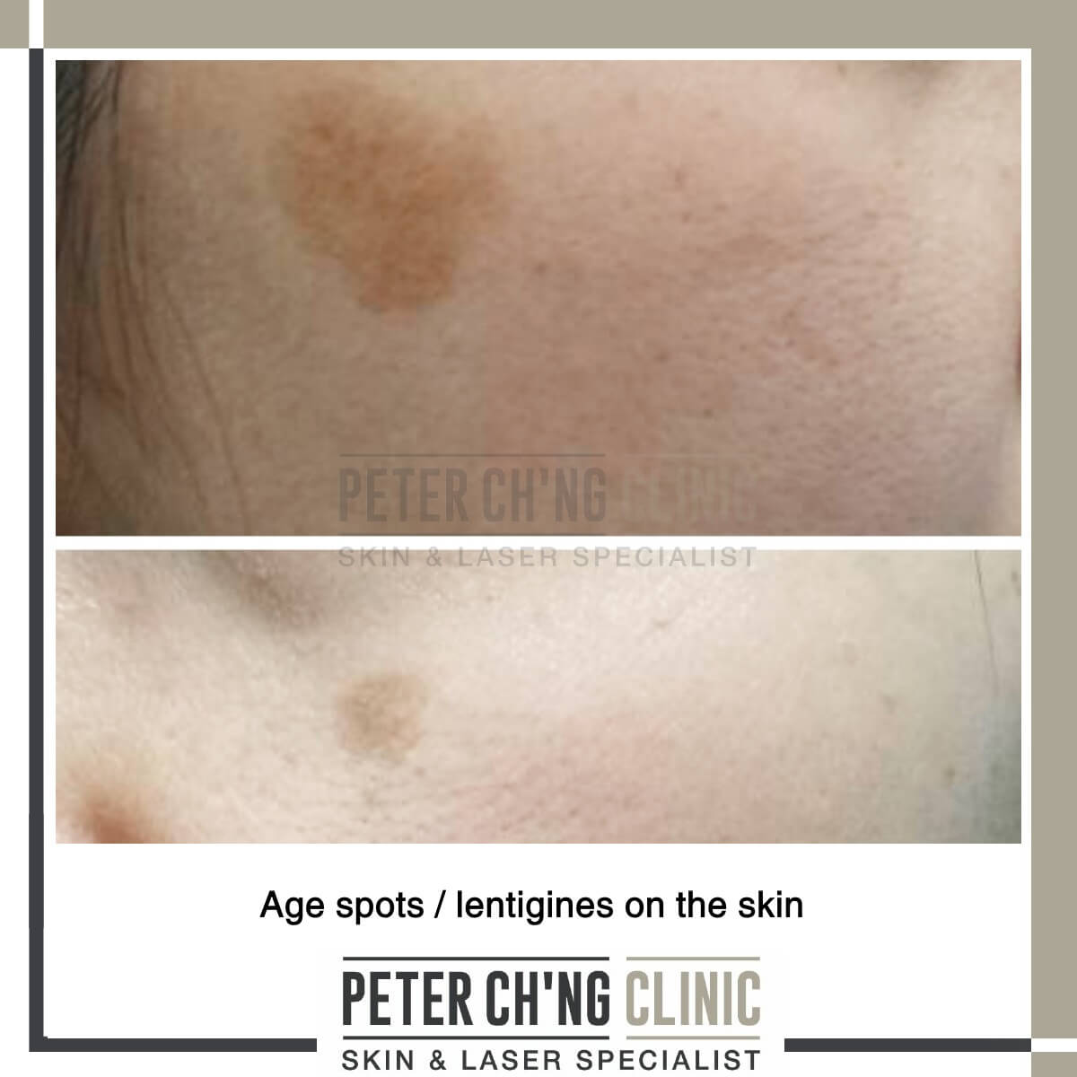 Age spots