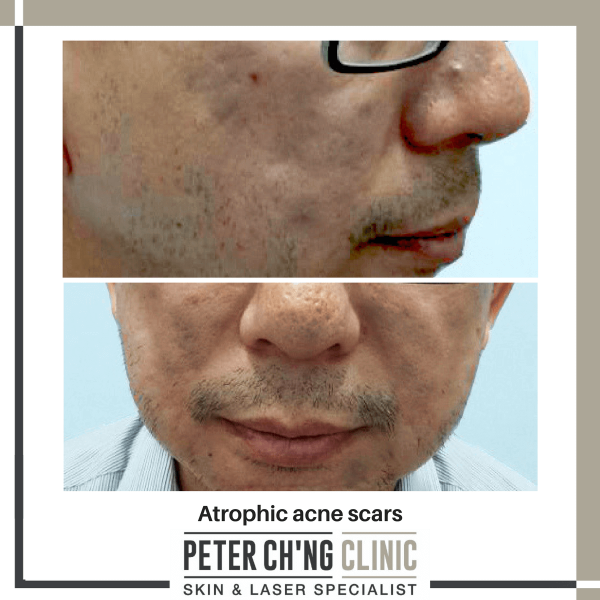 Atrophic acne scars