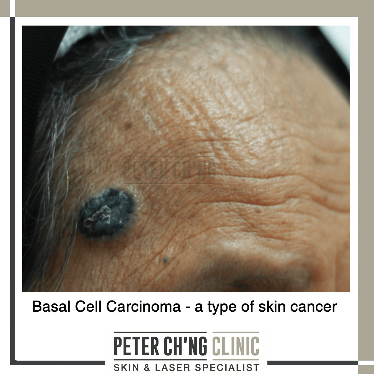 Basal cell carcinoma