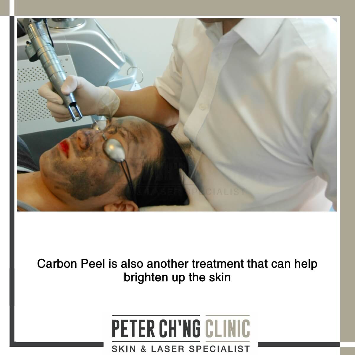 Carbon peel for dull skin