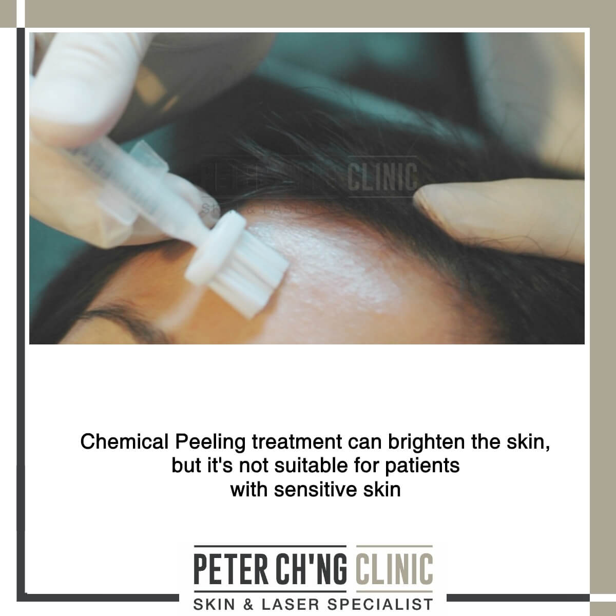 Chemical Peel for dull skin