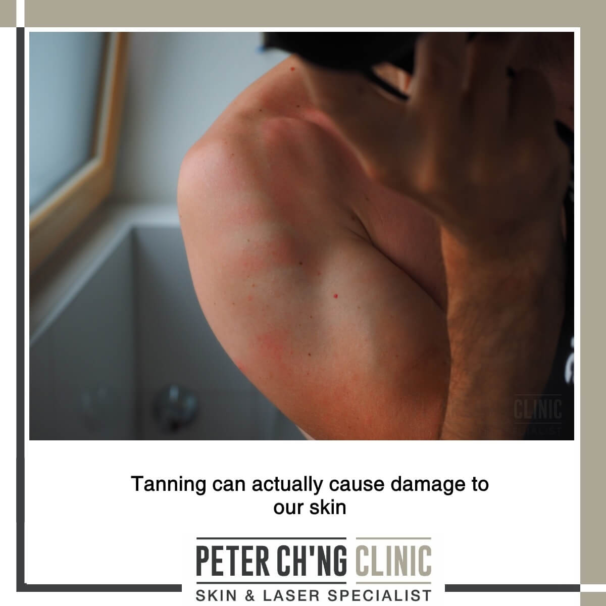Tanning causes skin damage