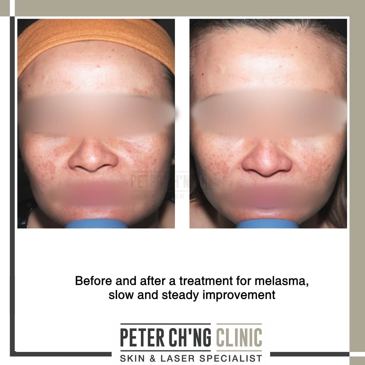 Before and after melasma treatment