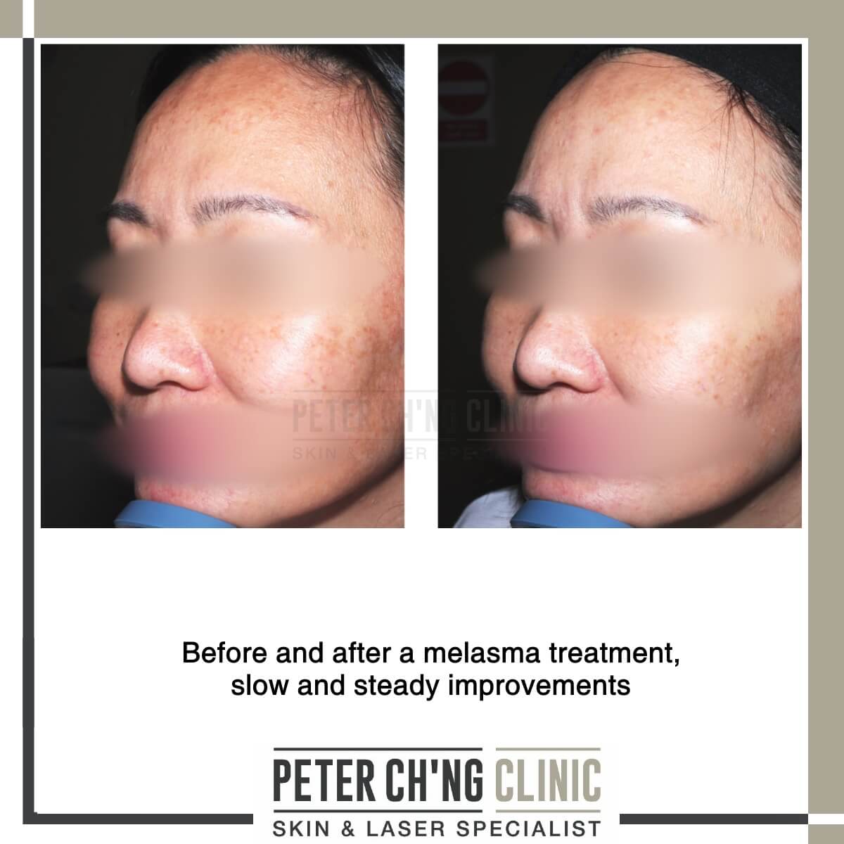 Before and after melasma treatment