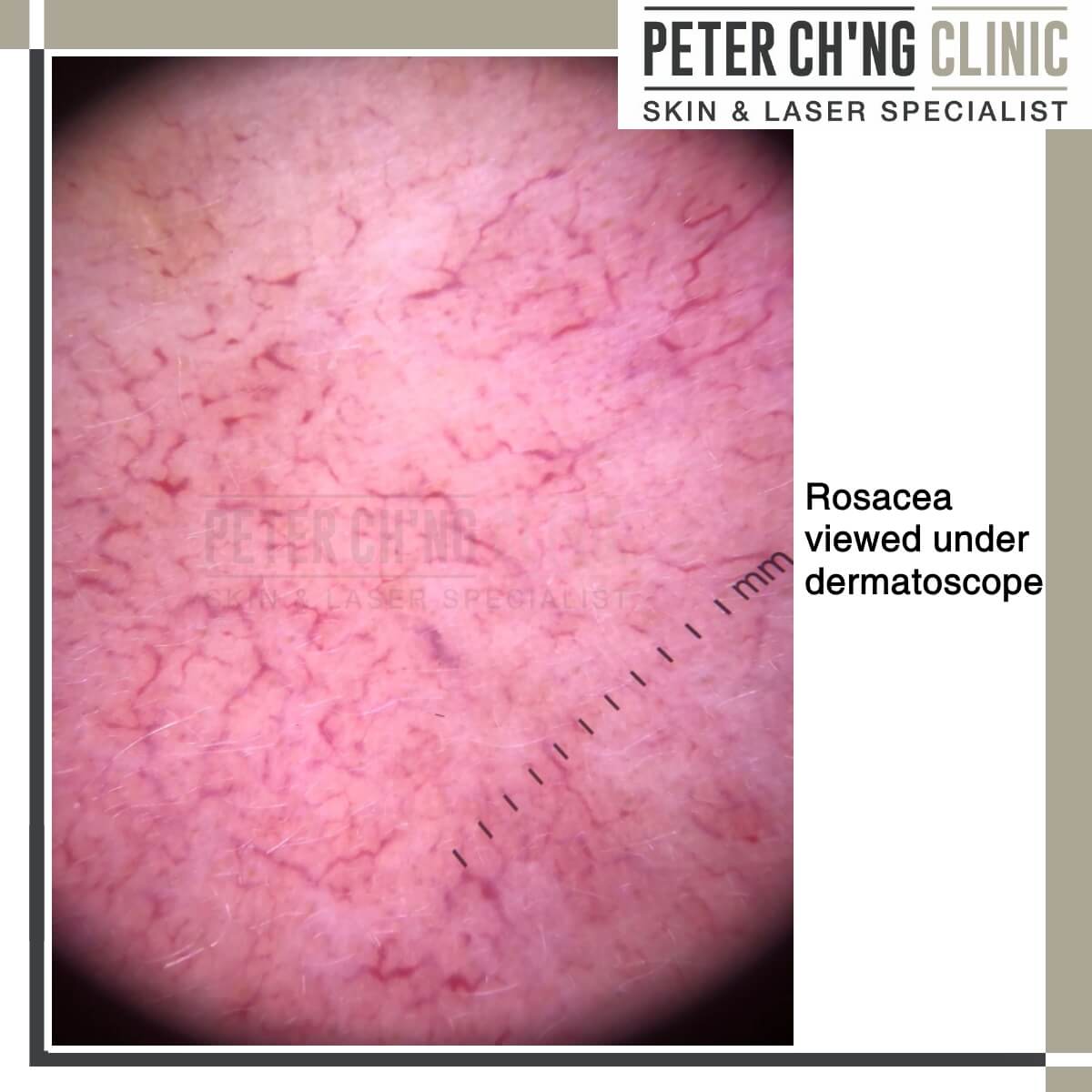 Rosacea under a dermatoscope