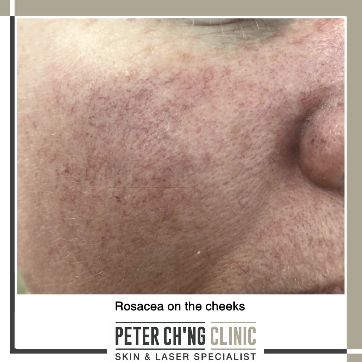 Rosacea on the cheeks