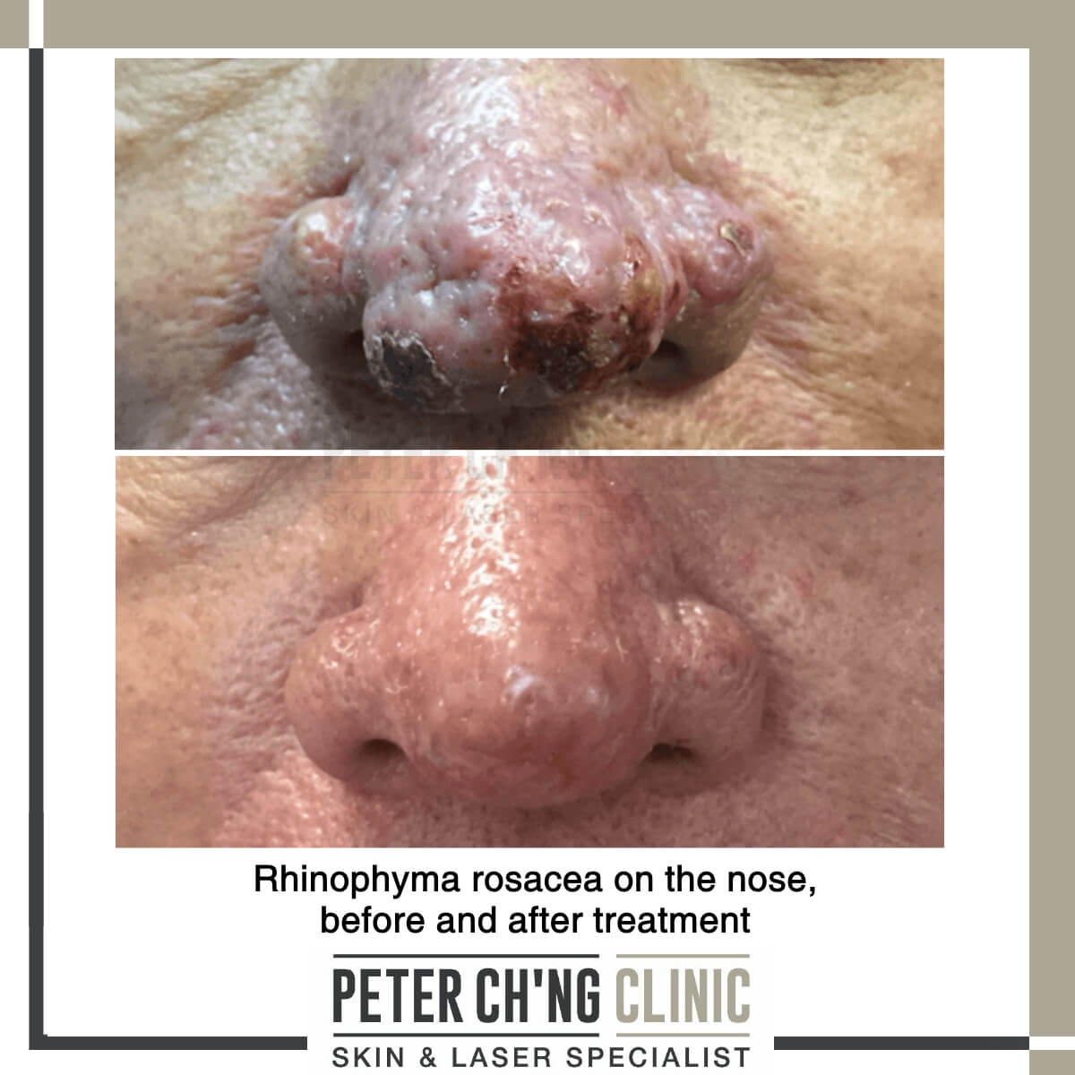 Phymatous rosacea