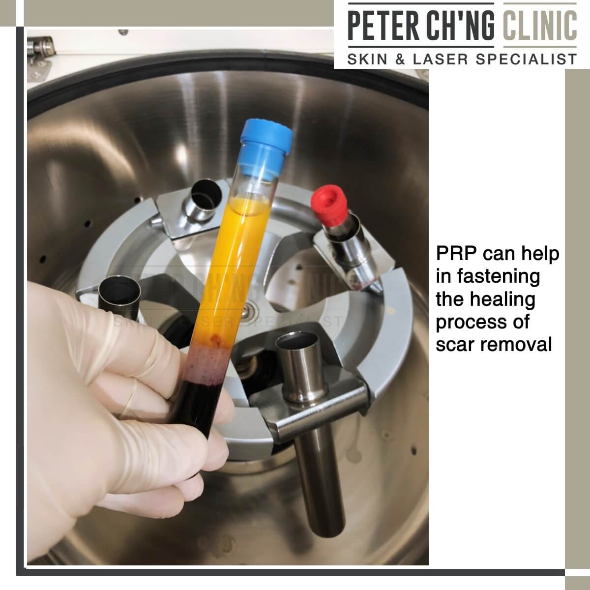 PRP treatment