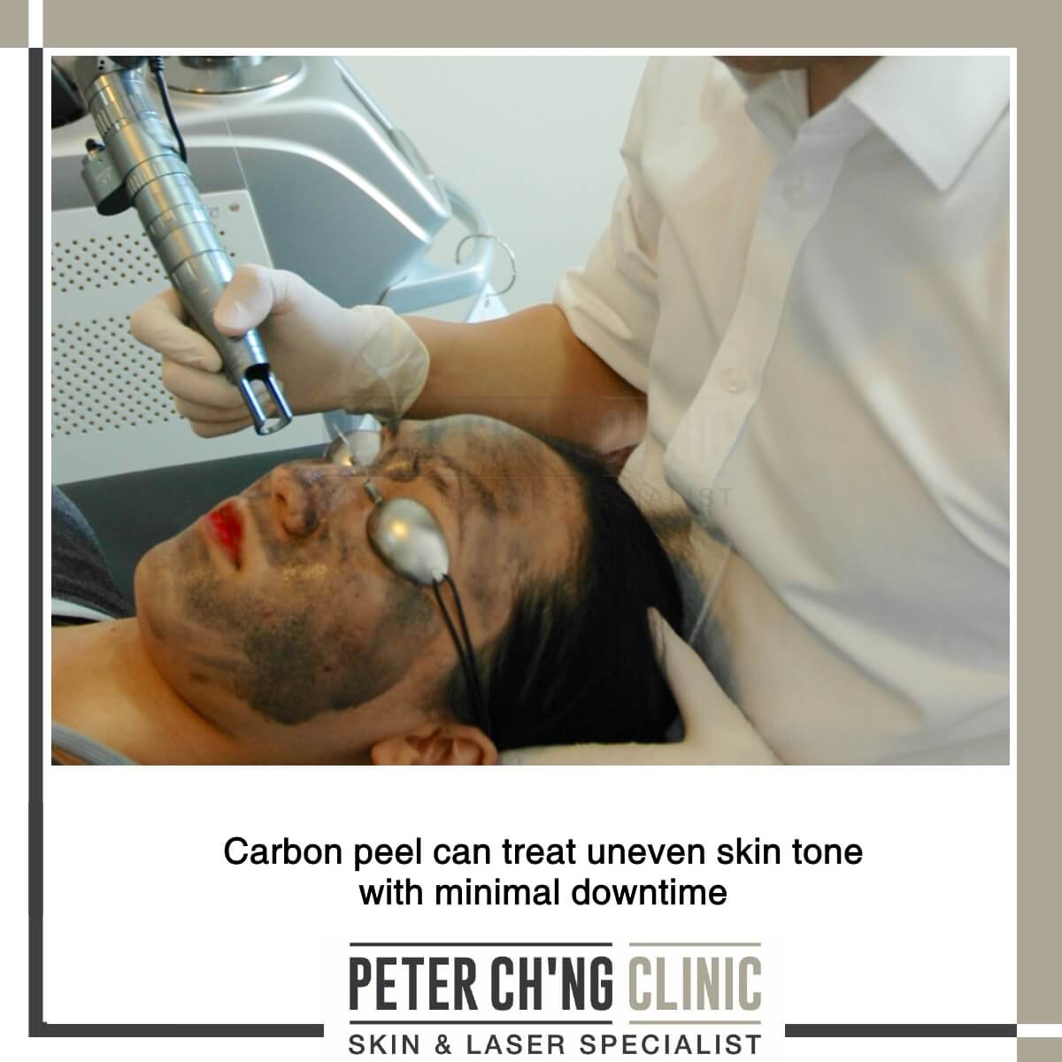 Carbon peel for uneven skin tone
