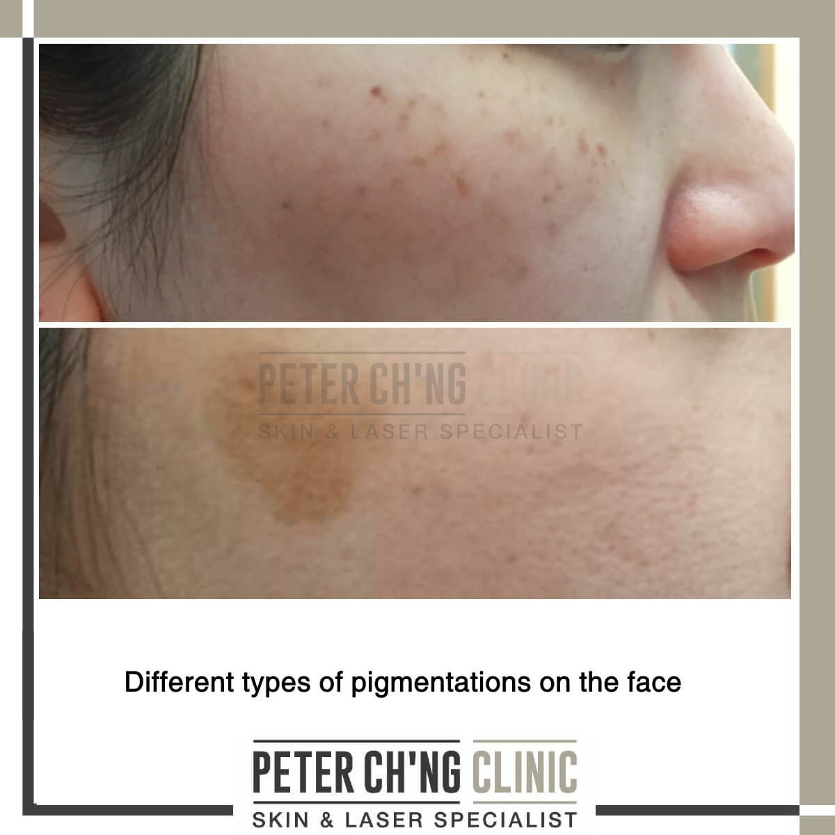 Different types of pigmentation