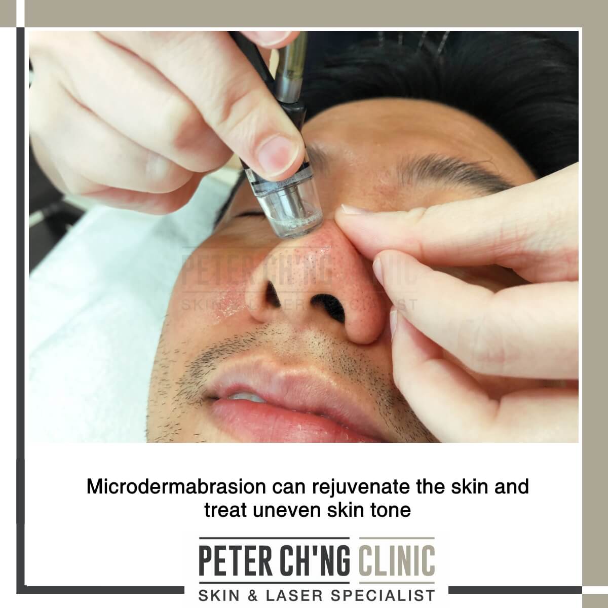 Microdermabrasion for skin rejuvenation