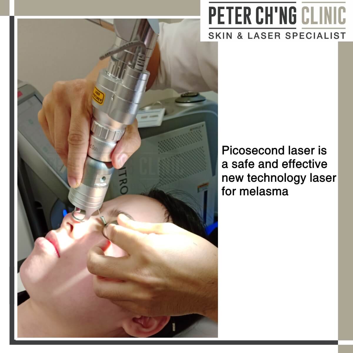 Picosecond laser for melasma