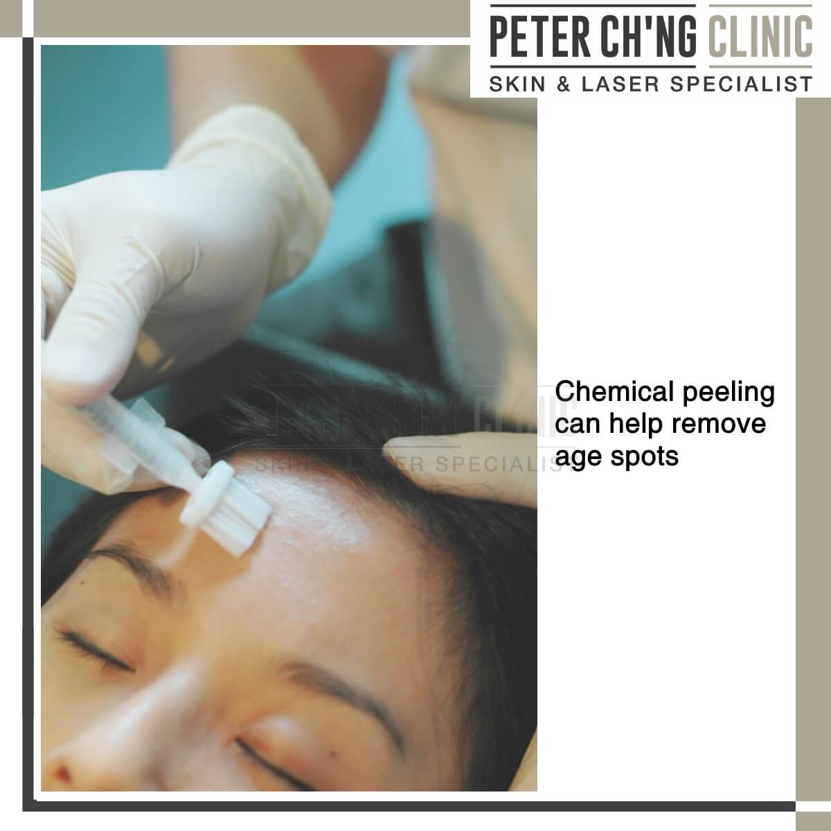 Chemical peel