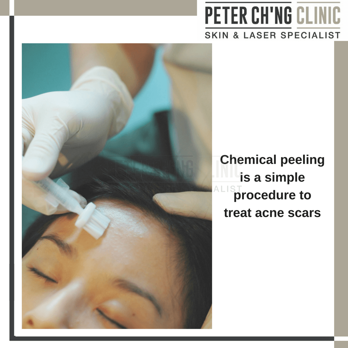 Chemical peel