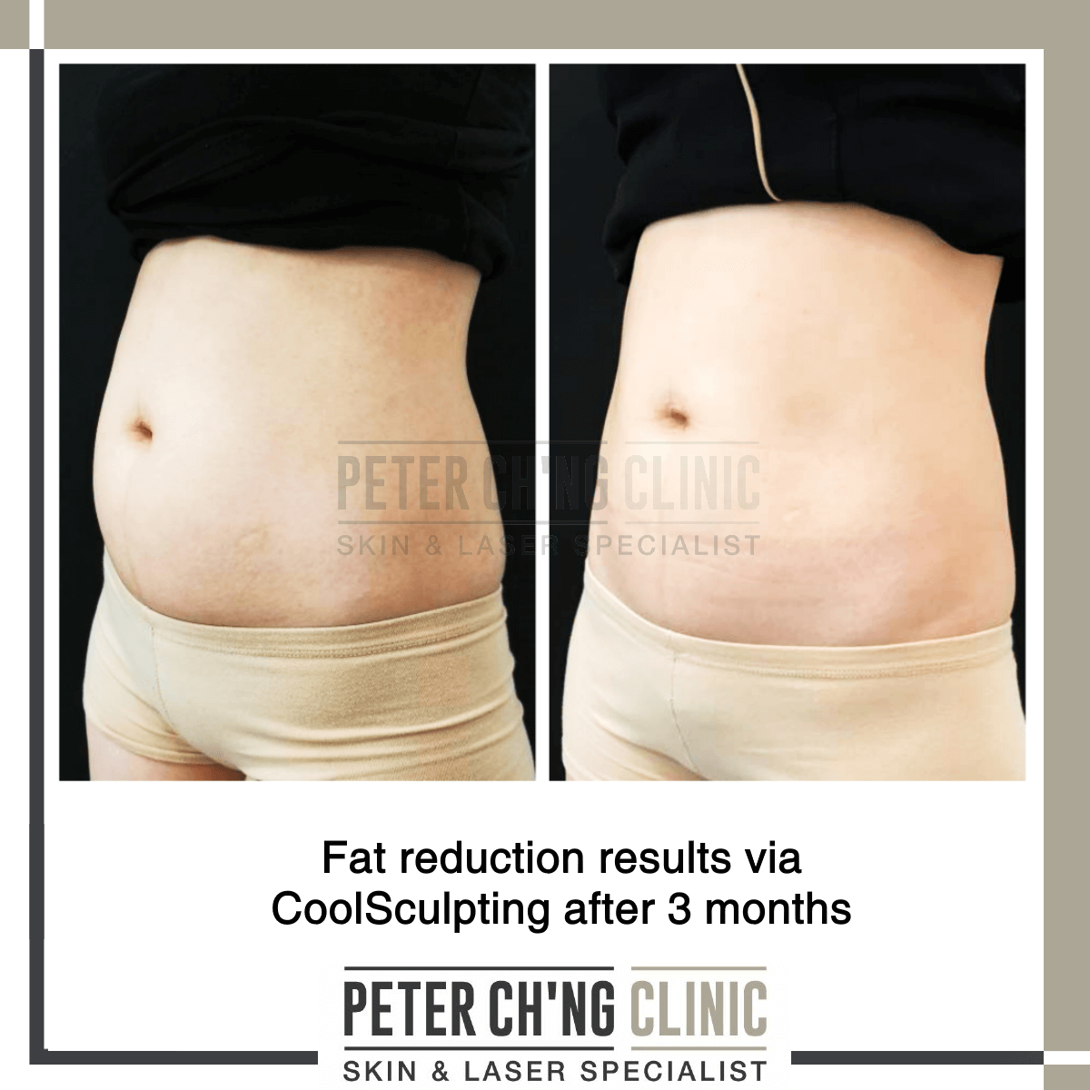 Coolsculpting