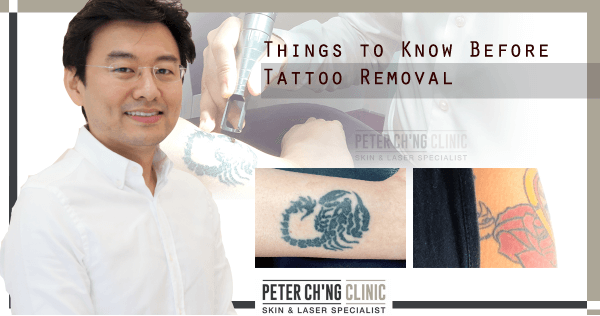 What not to do before a laser tattoo removal treatment