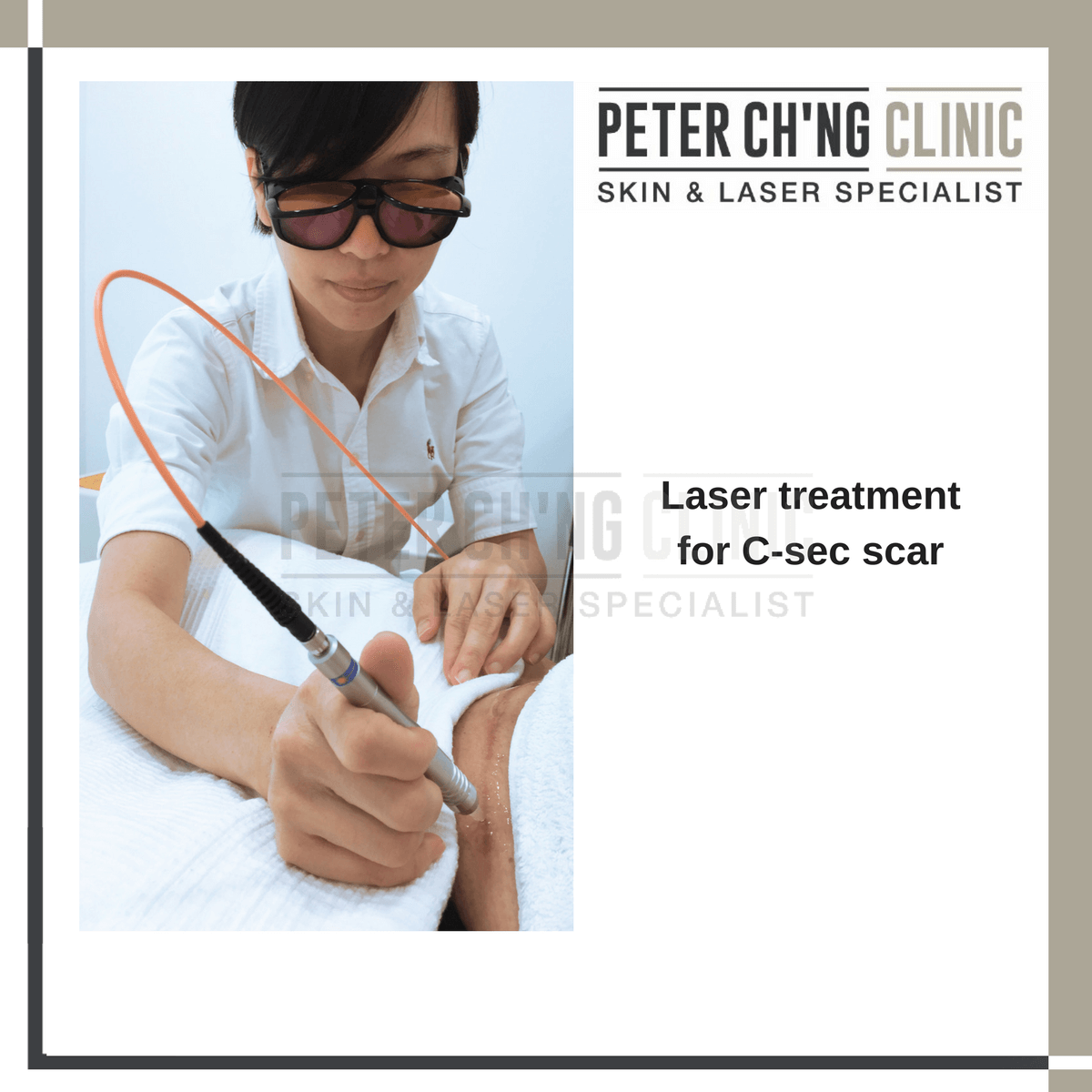Laser treatment for c-sec scar