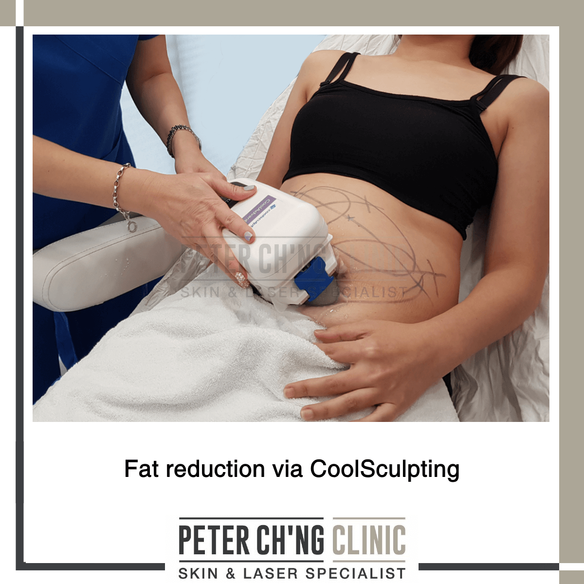 Fat reduction via CoolSculpting