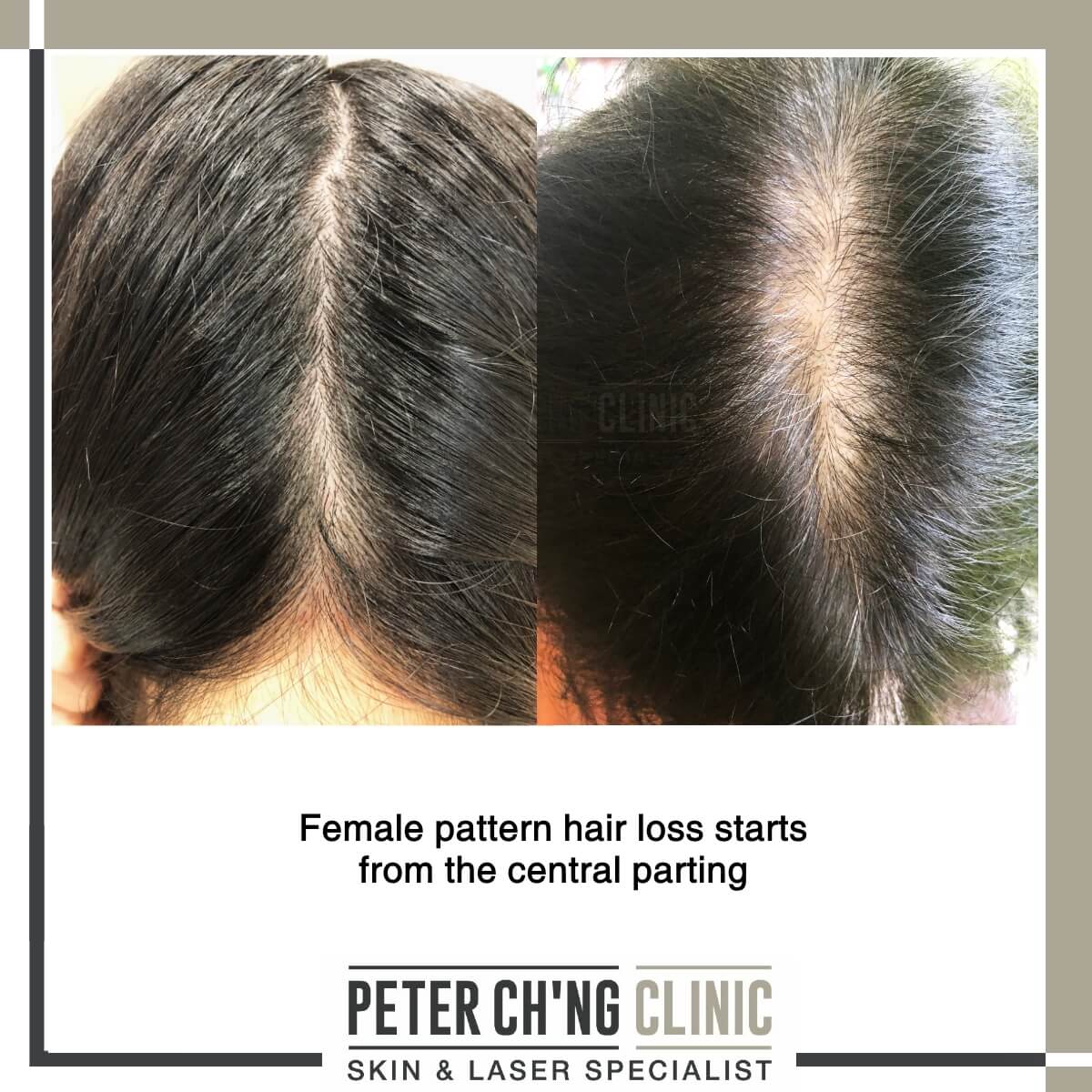 Female Pattern Hair Loss