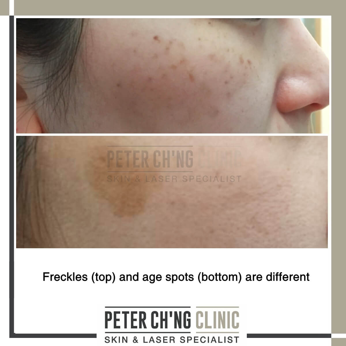 Age spots and freckles