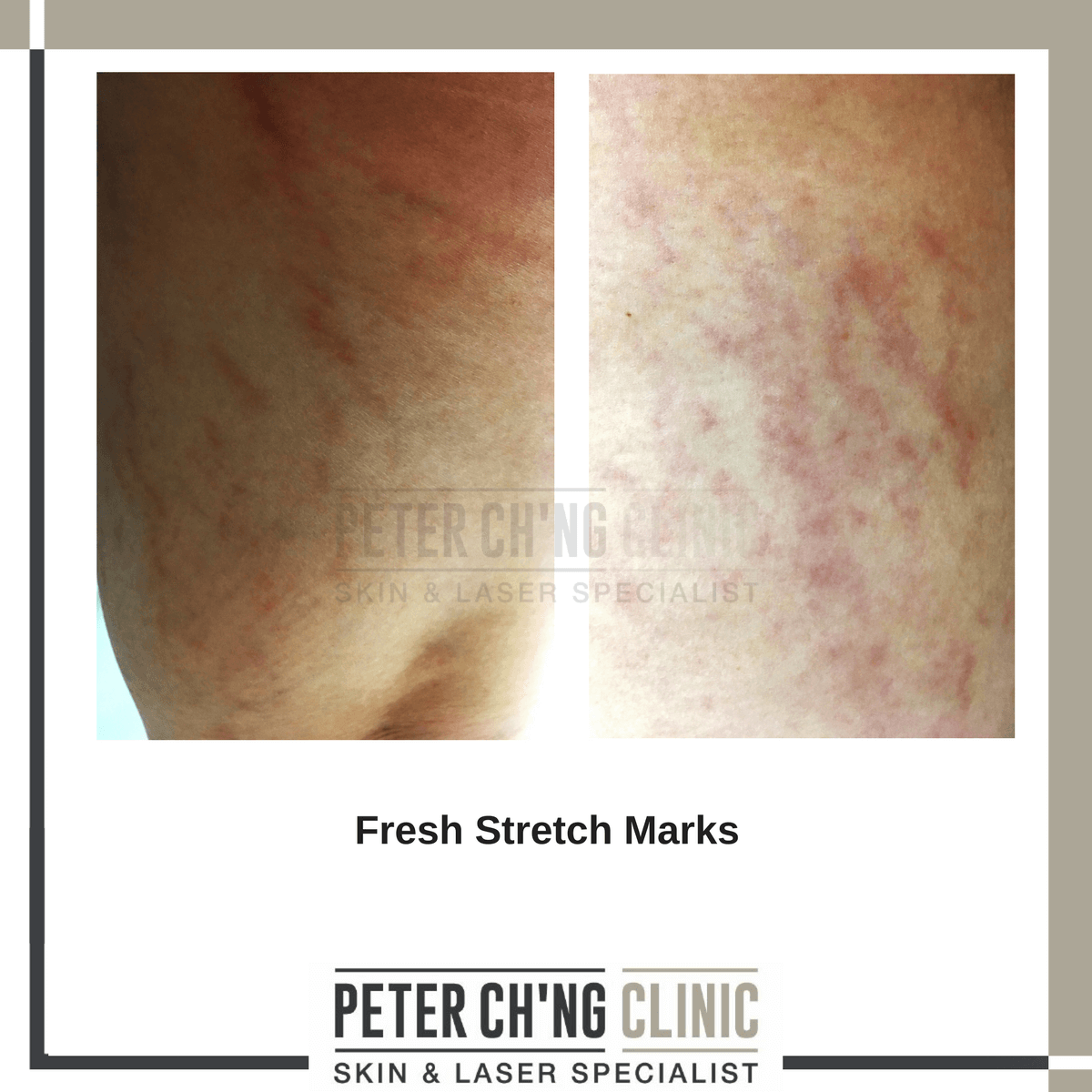 Fresh stretch marks