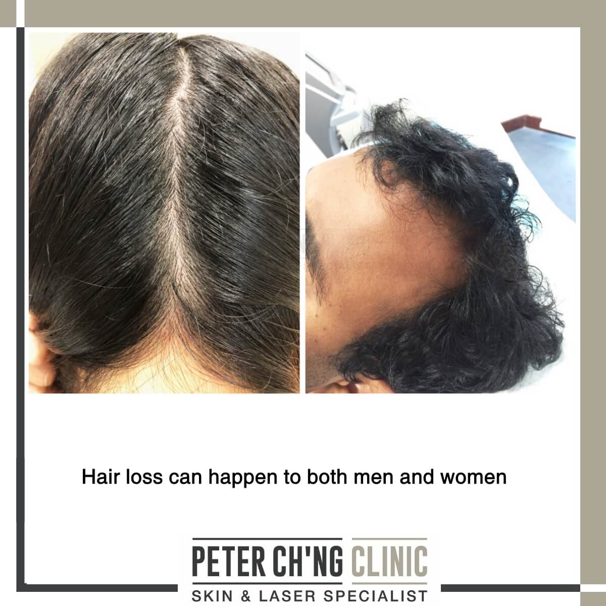 TRT and Hair Loss or Growth  How Testosterone Affects Your Hair   HRTGuru