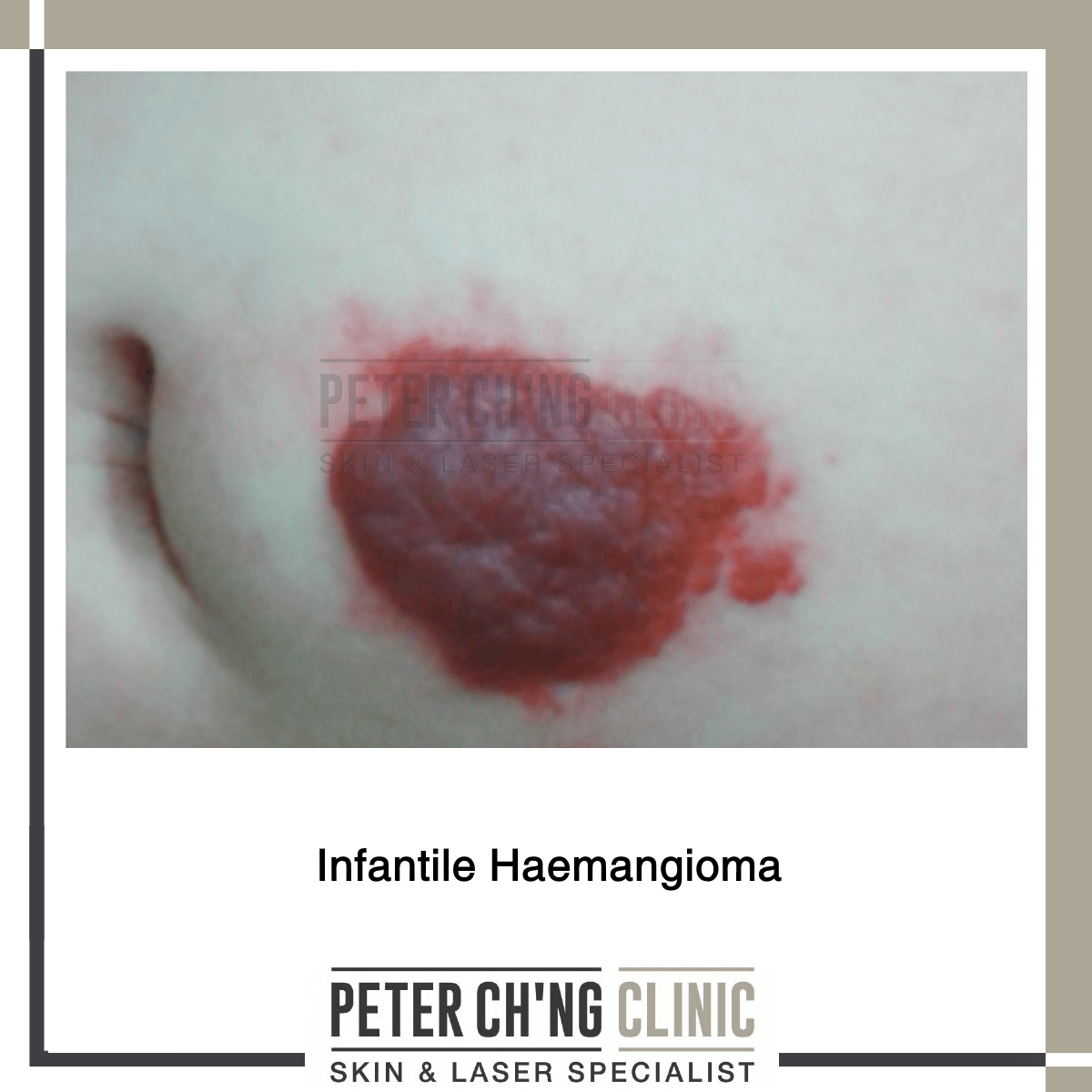 Infantile Haemangioma